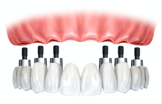 Implantes Dentales: Tratamientos de CLIESDENT - Clínica de Especialistas Dentales