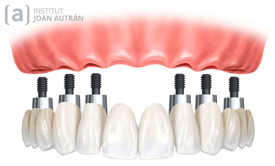 Implantes Dentales: Tratamientos de Cliesdent Clínica de Especialistas Dentales - Nueva Dirección! Implantes Dentales: Tratamientos de Cliesdent Clínica de Especialistas Dentales - Nueva Dirección!