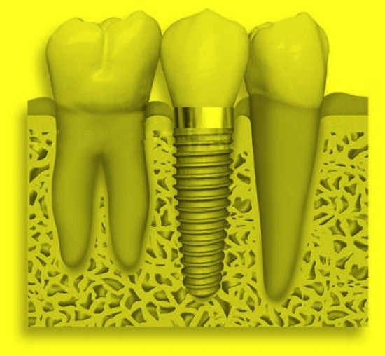 Implantes Dentales: Tratamientos de Cliesdent Clínica de Especialistas Dentales - Nueva Dirección! Implantes Dentales: Tratamientos de Cliesdent Clínica de Especialistas Dentales - Nueva Dirección!