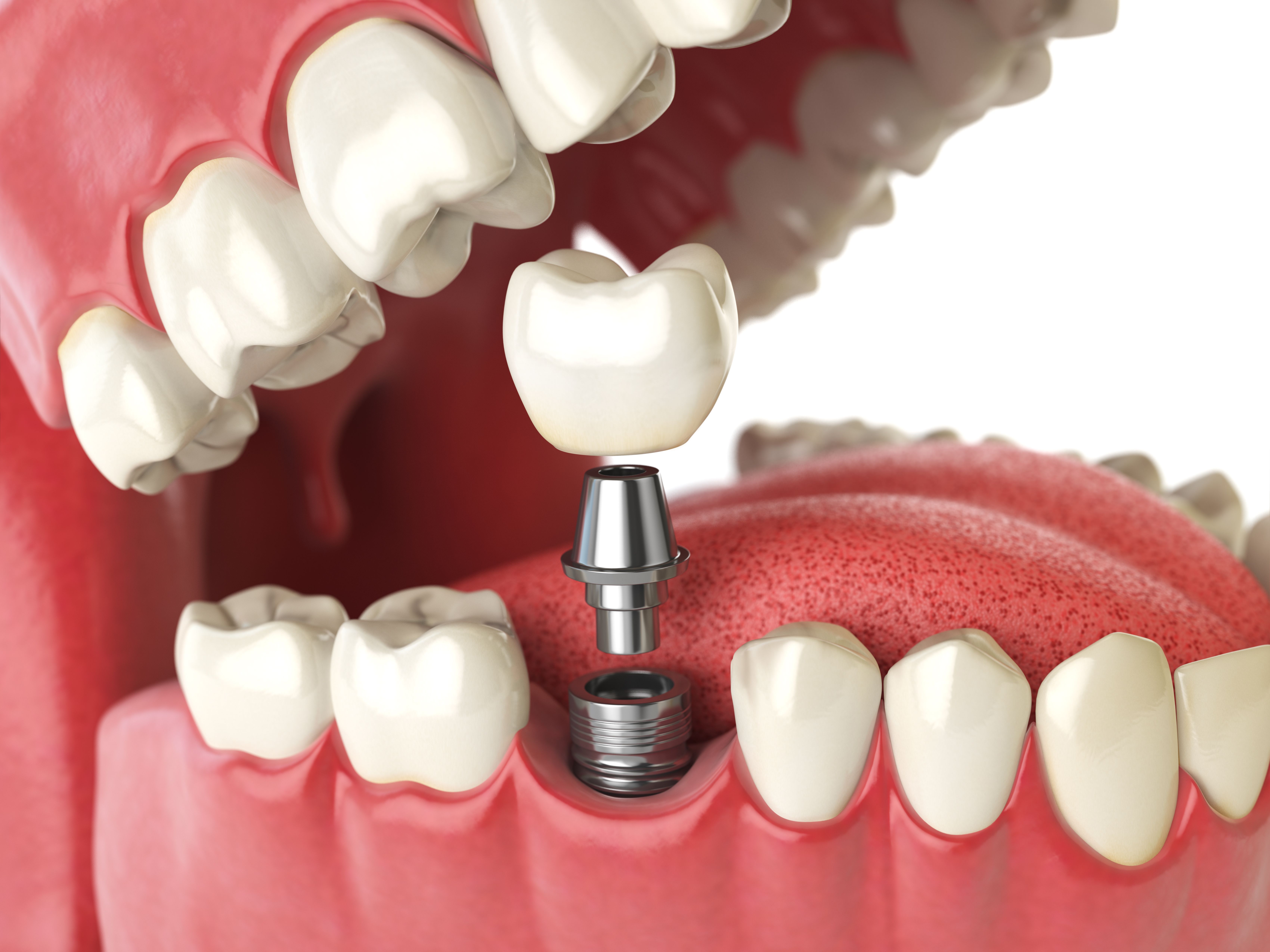 Implantes dentales en San Fernando