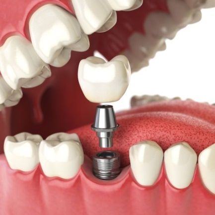 Implantología avanzada: Tratamientos de Clínica Dental Ruiz Jalón