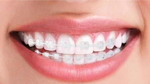 Ortodoncia convencional: Tratamientos de Clínica Dental Ruiz Jalón }}