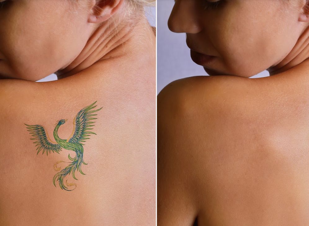 Eliminación de tatuajes: Servicios de Centro de Salud y Belleza, Mariam Navarro Eliminación de tatuajes: Servicios de Centro de Salud y Belleza, Mariam Navarro