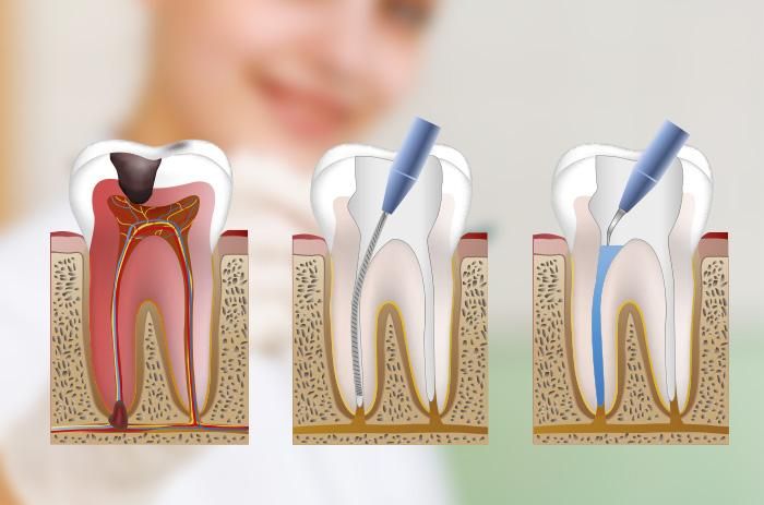 Endodoncias: Tratamientos de Tuboca+ Clínica dental Goya Endodoncias: Tratamientos de Tuboca+ Clínica dental Goya