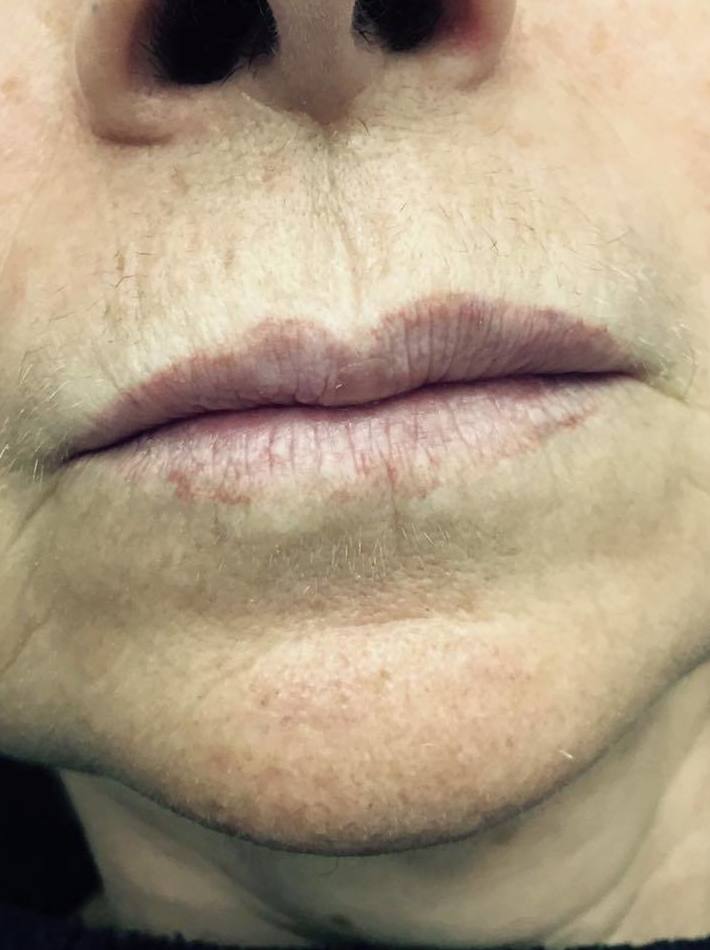 antes de una micropigmentación de labios antes de una micropigmentación de labios