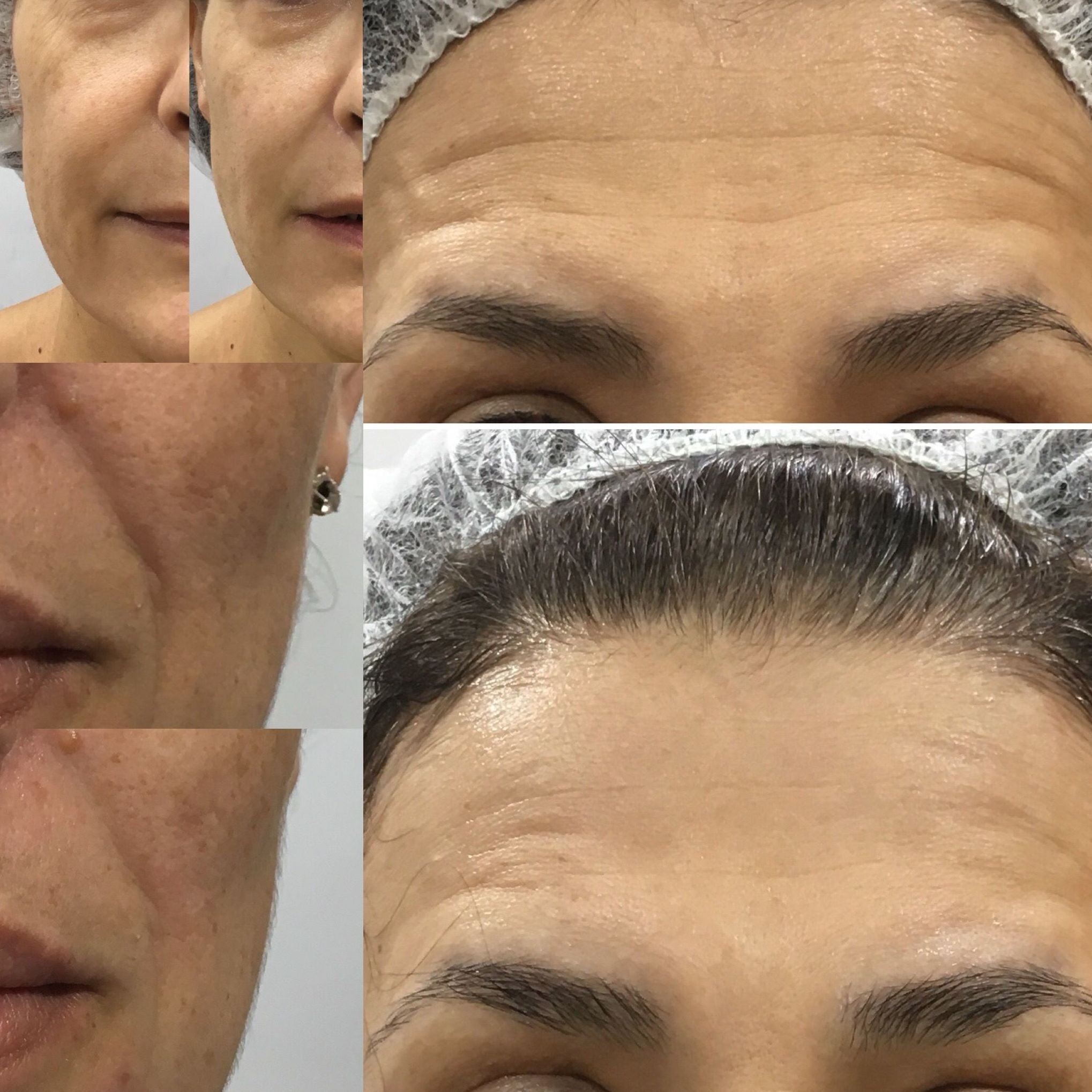 Antes y después de una sesión de tratamiento HIFU Antes y después de una sesión de tratamiento HIFU