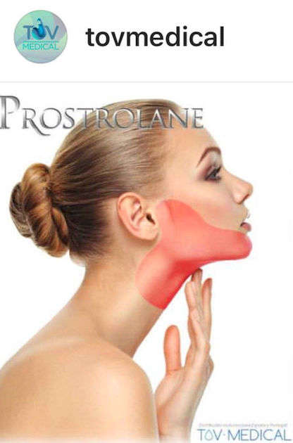 Definición del contorno mandibular con prostolane Definición del contorno mandibular con prostolane