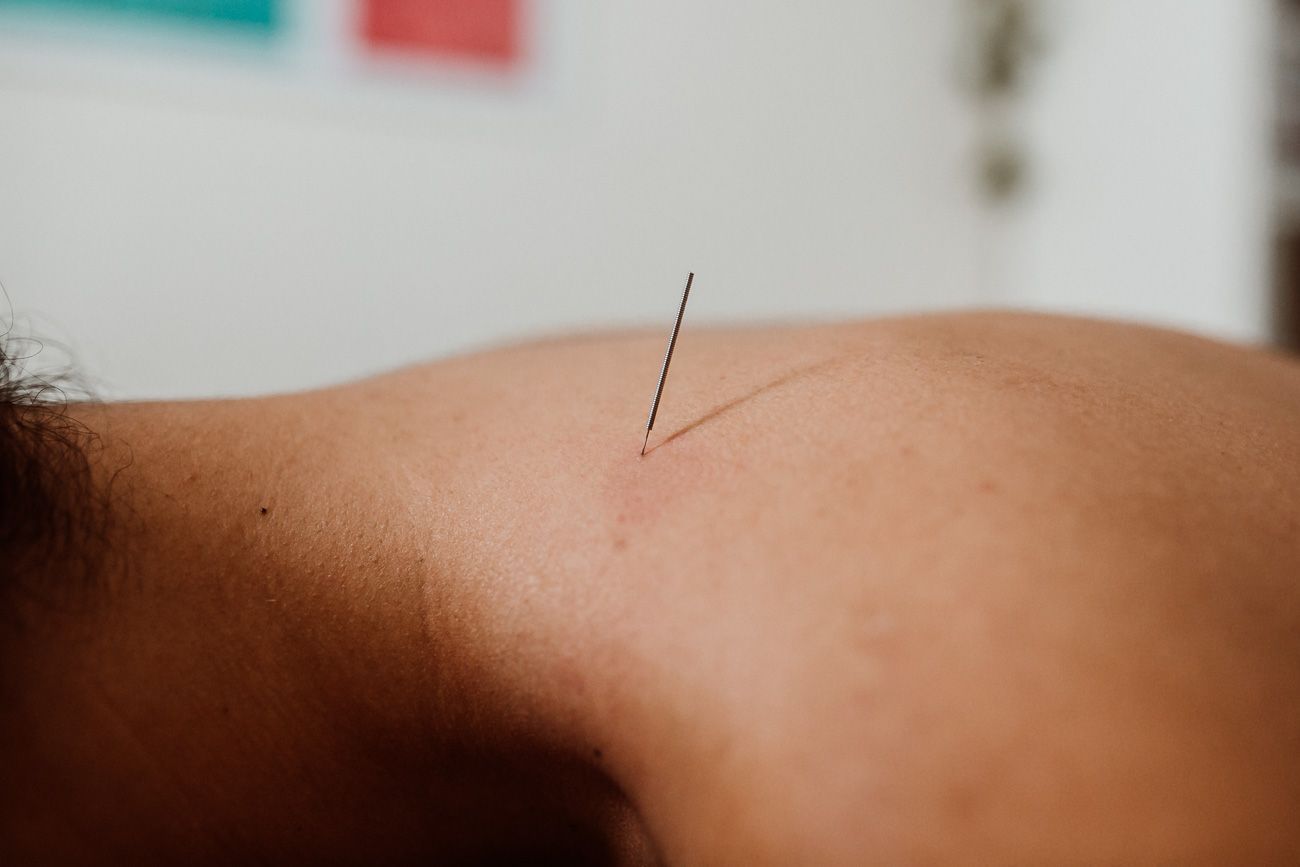 Punción seca: Terapias de MQ Fisioterapia Punción seca: Terapias de MQ Fisioterapia