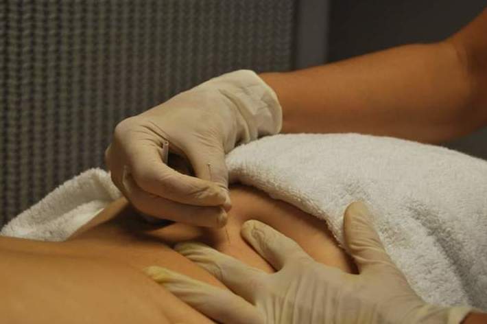Punción seca: Terapias de MQ Fisioterapia Punción seca: Terapias de MQ Fisioterapia