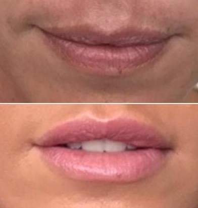 Aumento de labios con ácido hialurónico.
