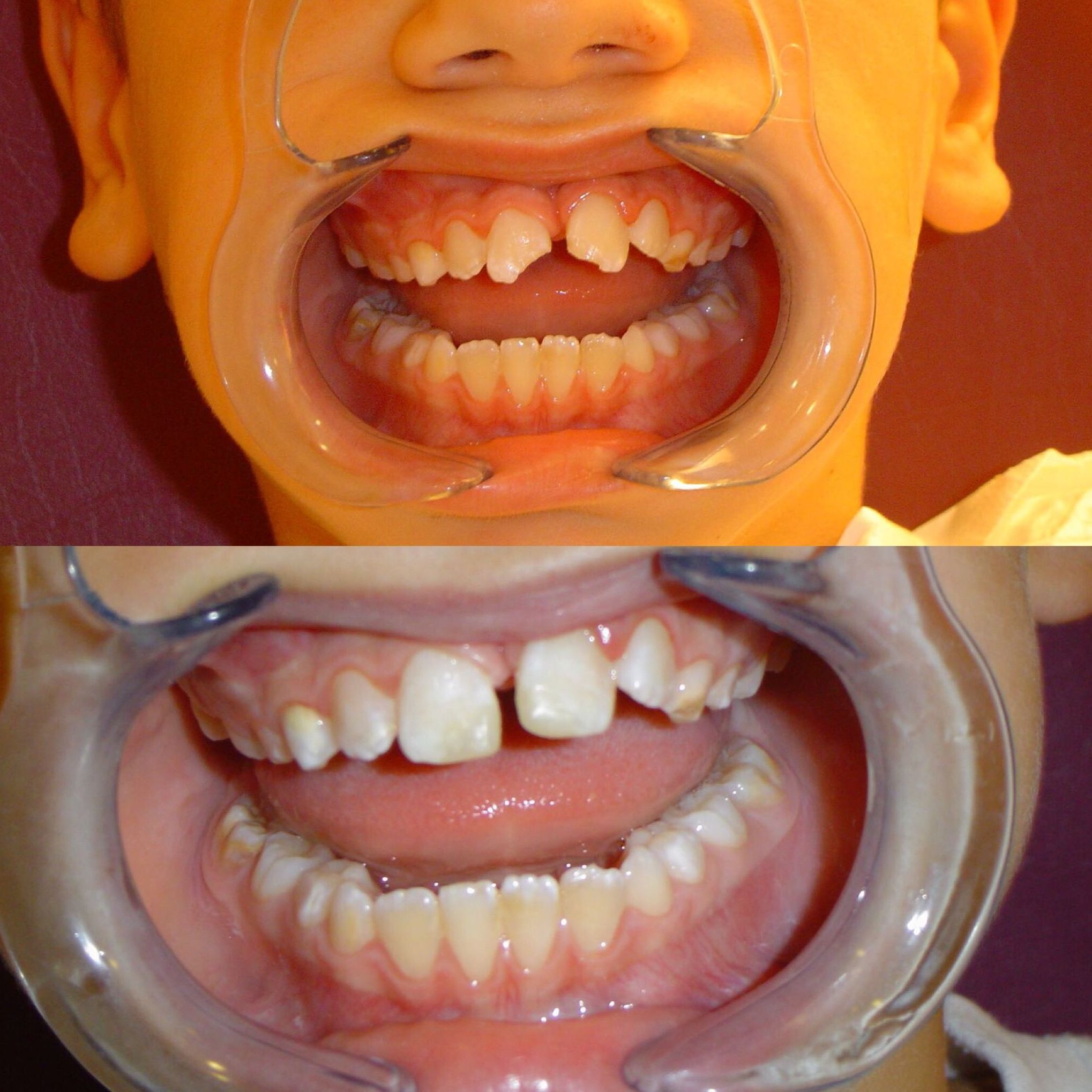 Boca de uno de nuestros pacientes antes y después del tratamiento