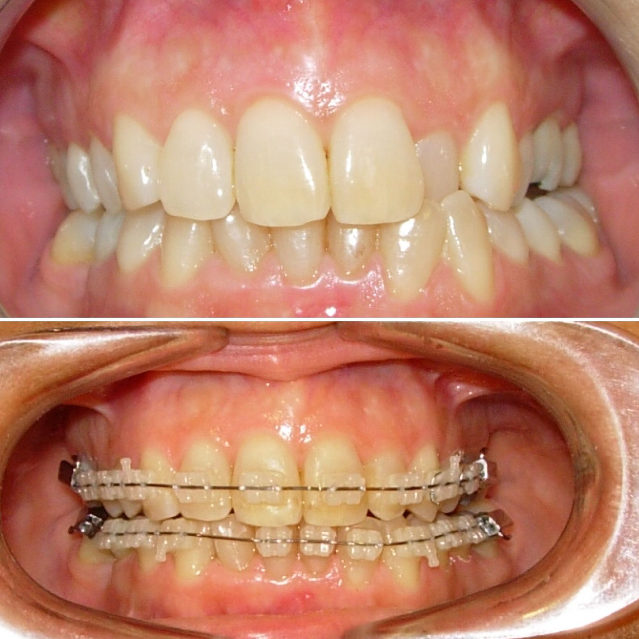 Ortodoncia transparente, resultados visibles