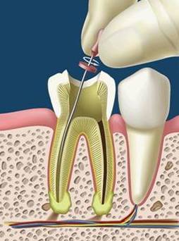 Endodoncia: Servicios de Clínica Dental El Carmen