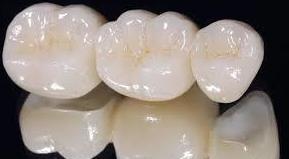 Prótesis Fijas de Porcelana o de zirconio: Servicios de Clínica Dental Dra. Belkys Hernández Cabrera Prótesis Fijas de Porcelana o de zirconio: Servicios de Clínica Dental Dra. Belkys Hernández Cabrera