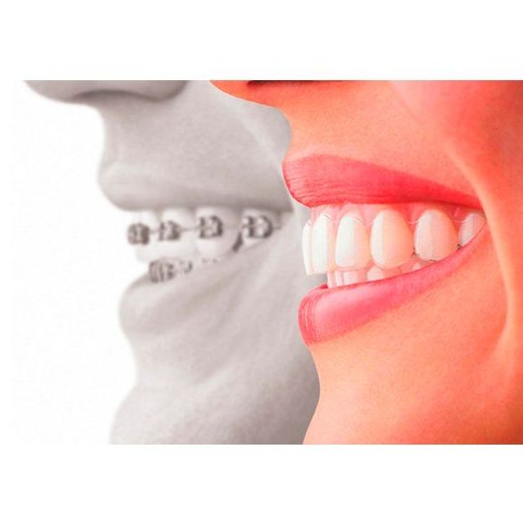 Ortodoncia : Servicios de Clínica Dental Dra. Belkys Hernández Cabrera Ortodoncia : Servicios de Clínica Dental Dra. Belkys Hernández Cabrera