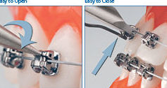 ORTODONCIA BRACKETS DAMON ORTODONCIA BRACKETS DAMON
