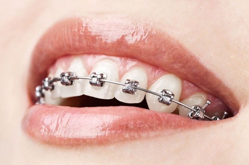 BRACKETS BRACKETS