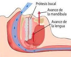 Esquema del funcionamiento de Aparato Intraoral para no Roncar Esquema del funcionamiento de Aparato Intraoral para no Roncar