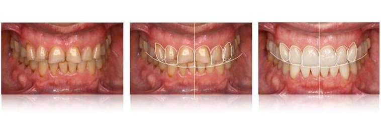 DISEÑO DE SONRISA DIGITAL: Servicios de Clínica Dental Dra. Belkys Hernández Cabrera DISEÑO DE SONRISA DIGITAL: Servicios de Clínica Dental Dra. Belkys Hernández Cabrera