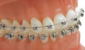 Los brackets Damon en ortodoncia fija con fuerzas ligeras Los brackets Damon en ortodoncia fija con fuerzas ligeras