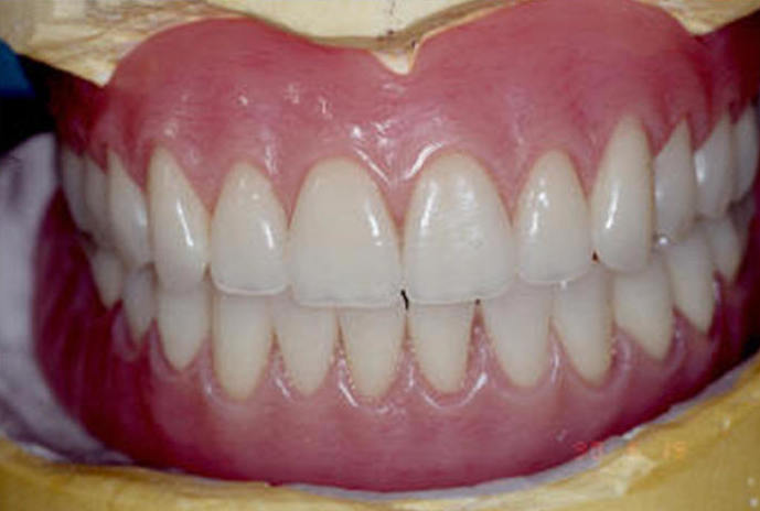 PROTESIS COMPLETAS: Servicios de Clínica Dental Dra. Belkys Hernández Cabrera PROTESIS COMPLETAS: Servicios de Clínica Dental Dra. Belkys Hernández Cabrera