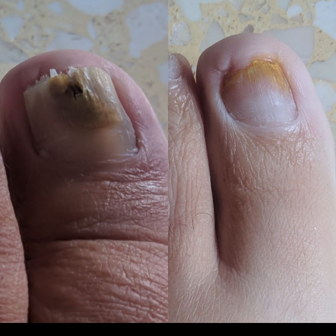 Tratamiento de uñas con láser Tratamiento de uñas con láser