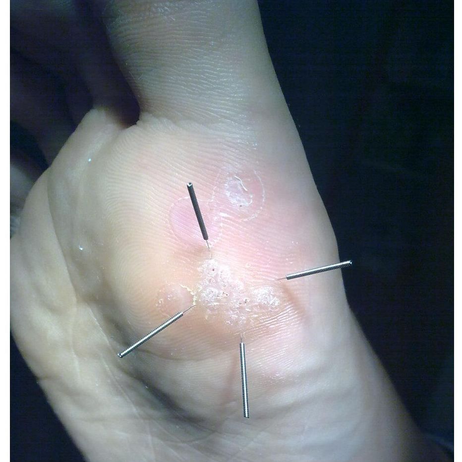 Tratamiento de verrugas con acupuntura: Servicios de Clínica de podología, biomecánica, fisioterapia y posturología Cristina L. Córdoba Tratamiento de verrugas con acupuntura: Servicios de Clínica de podología, biomecánica, fisioterapia y posturología Cristina L. Córdoba