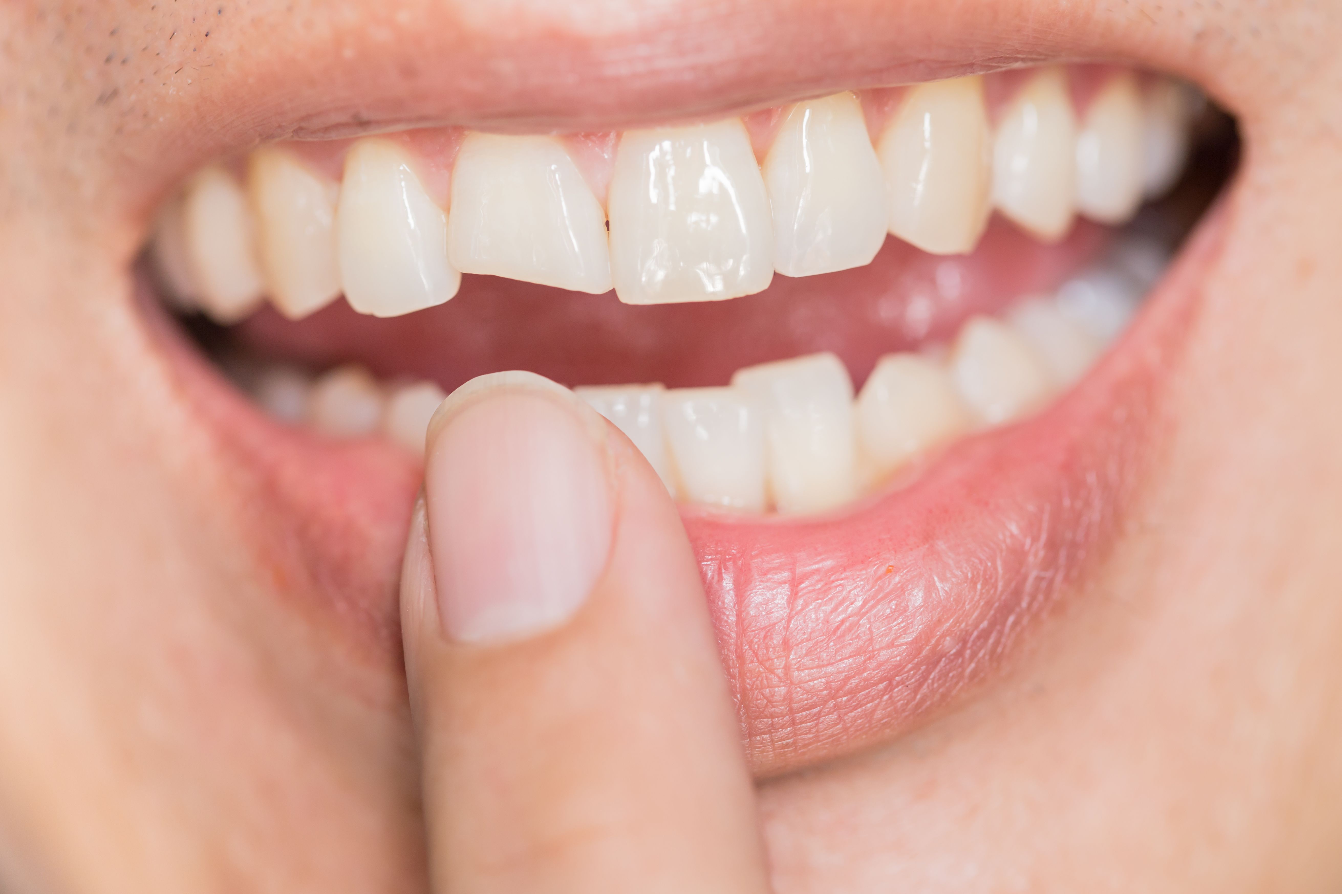 Carillas directas y restauraciones estéticas: Tratamientos de Centro Médico Dental Capitol Carillas directas y restauraciones estéticas: Tratamientos de Centro Médico Dental Capitol