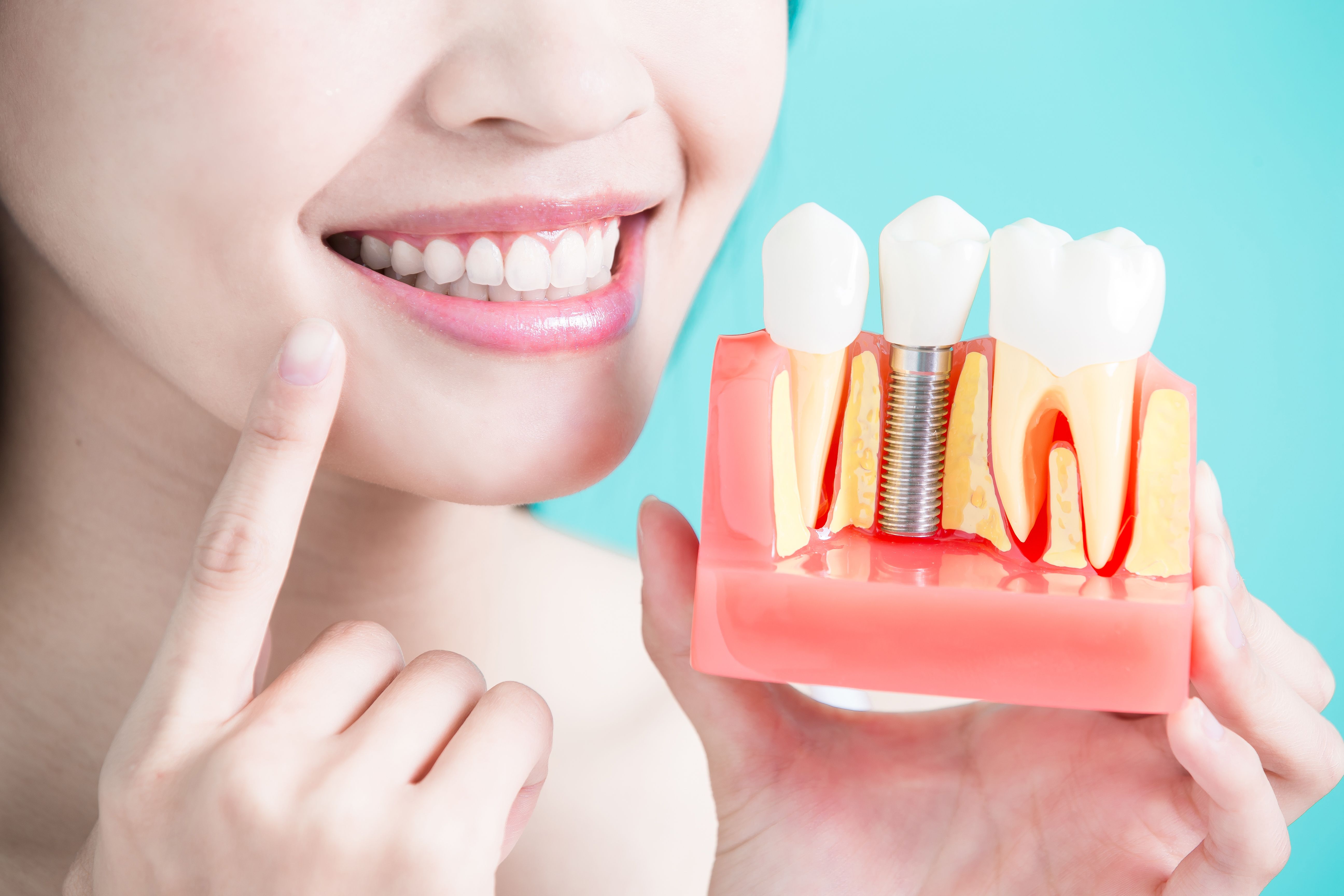 Intervención para implantes dentales: Tratamientos de Centro Médico Dental Capitol Intervención para implantes dentales: Tratamientos de Centro Médico Dental Capitol