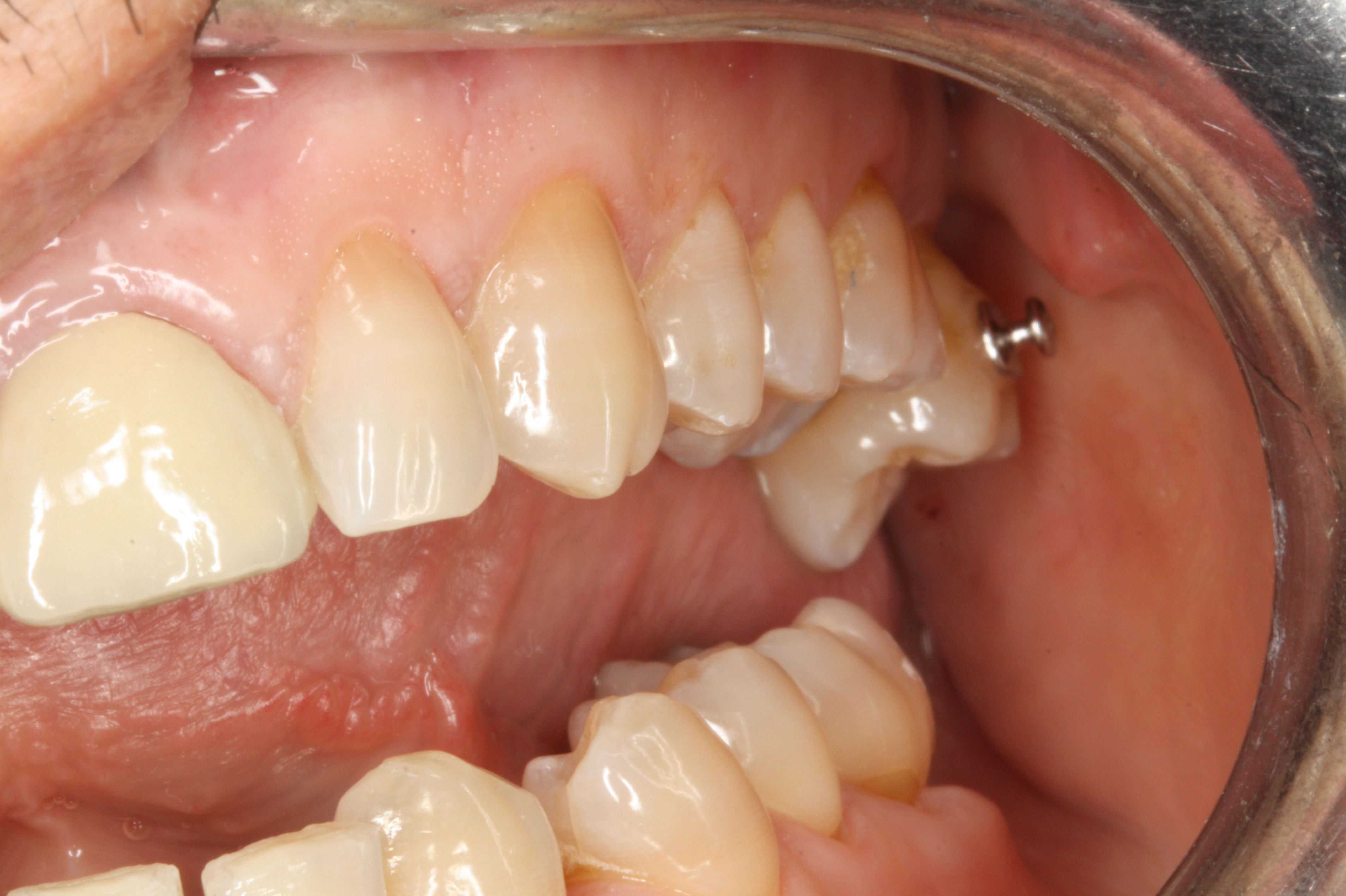 Microimplantes para ortodoncia: Tratamientos de Centro Médico Dental Capitol Microimplantes para ortodoncia: Tratamientos de Centro Médico Dental Capitol