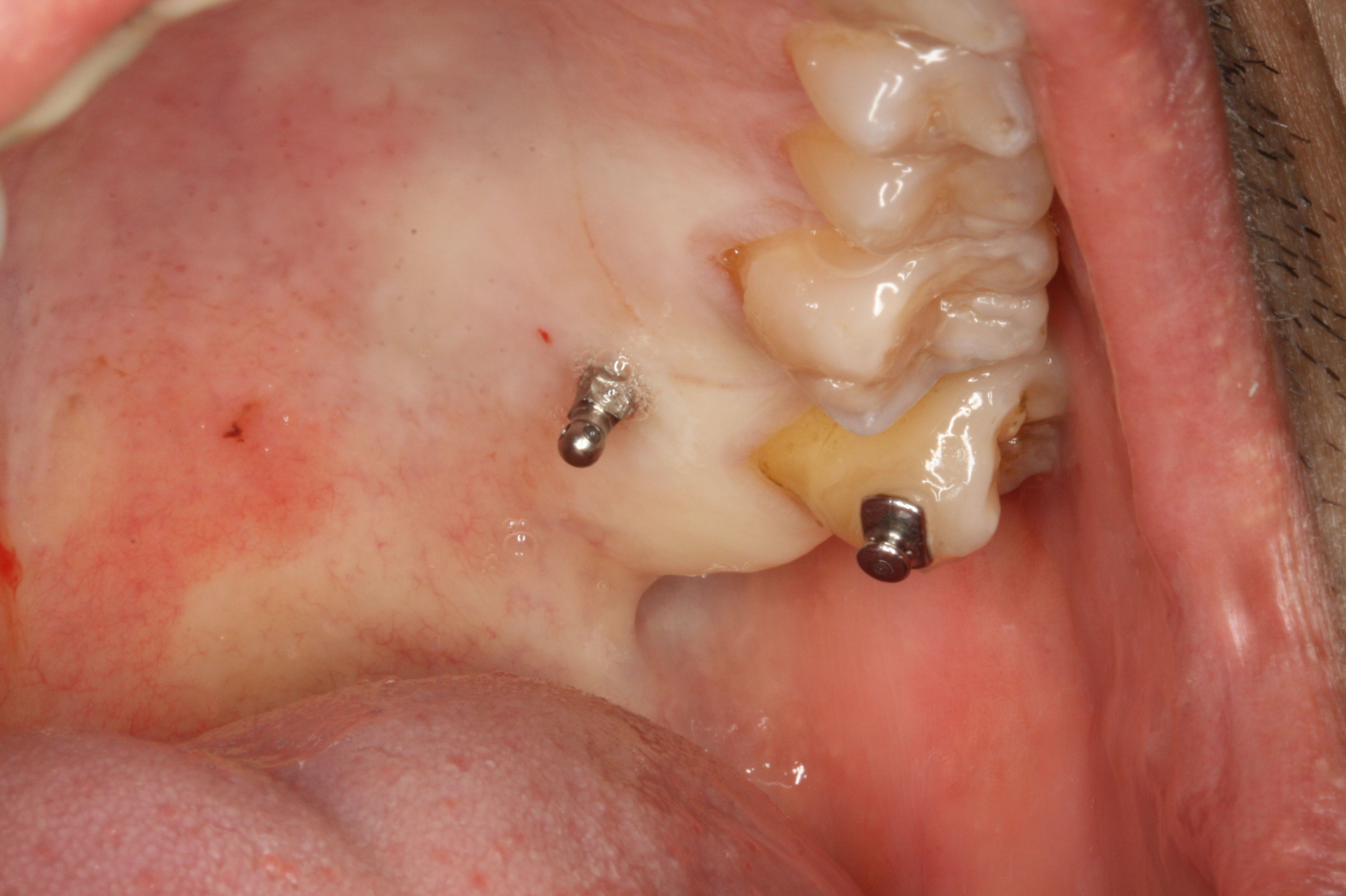 Microimplantes para ortodoncia: Tratamientos de Centro Médico Dental Capitol Microimplantes para ortodoncia: Tratamientos de Centro Médico Dental Capitol