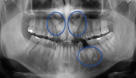 Caninos incluidos: Tratamientos de Centro Médico Dental Capitol Caninos incluidos: Tratamientos de Centro Médico Dental Capitol