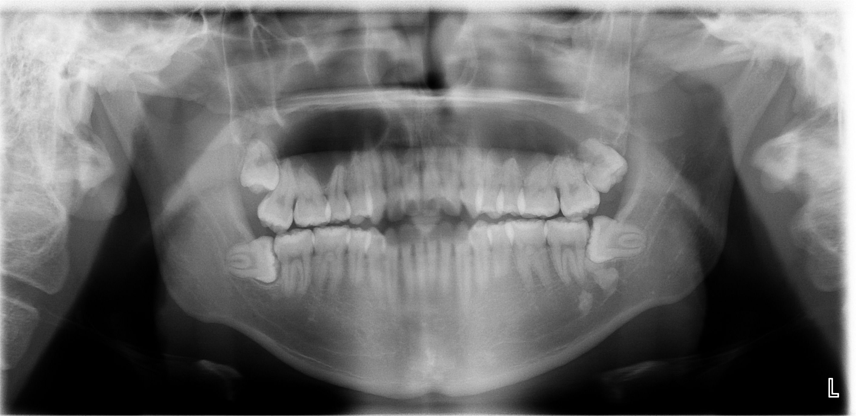 Muelas del juicio: Tratamientos de Centro Médico Dental Capitol Muelas del juicio: Tratamientos de Centro Médico Dental Capitol