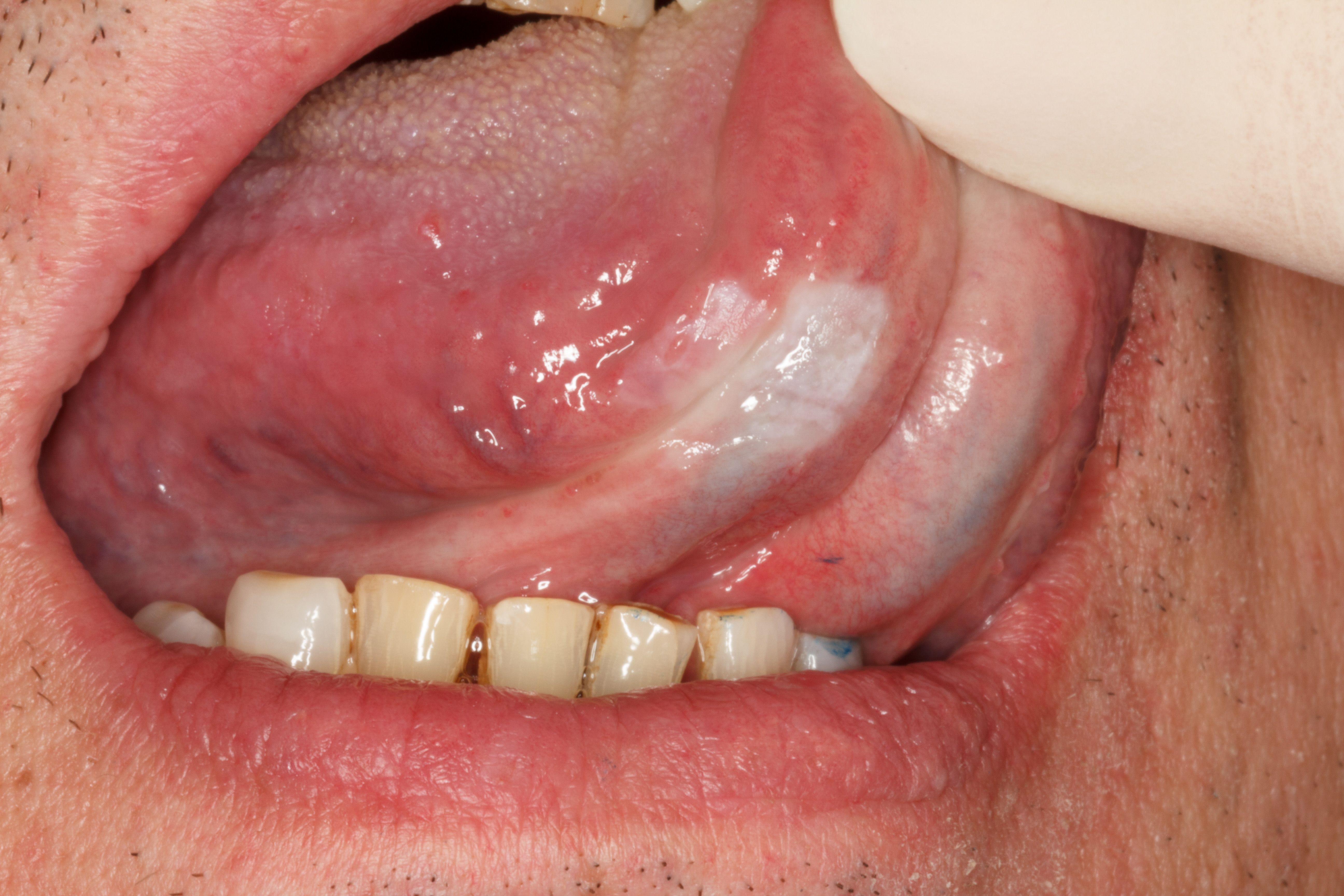 Lesiones bucales sospechosas: Tratamientos de Centro Médico Dental Capitol Lesiones bucales sospechosas: Tratamientos de Centro Médico Dental Capitol
