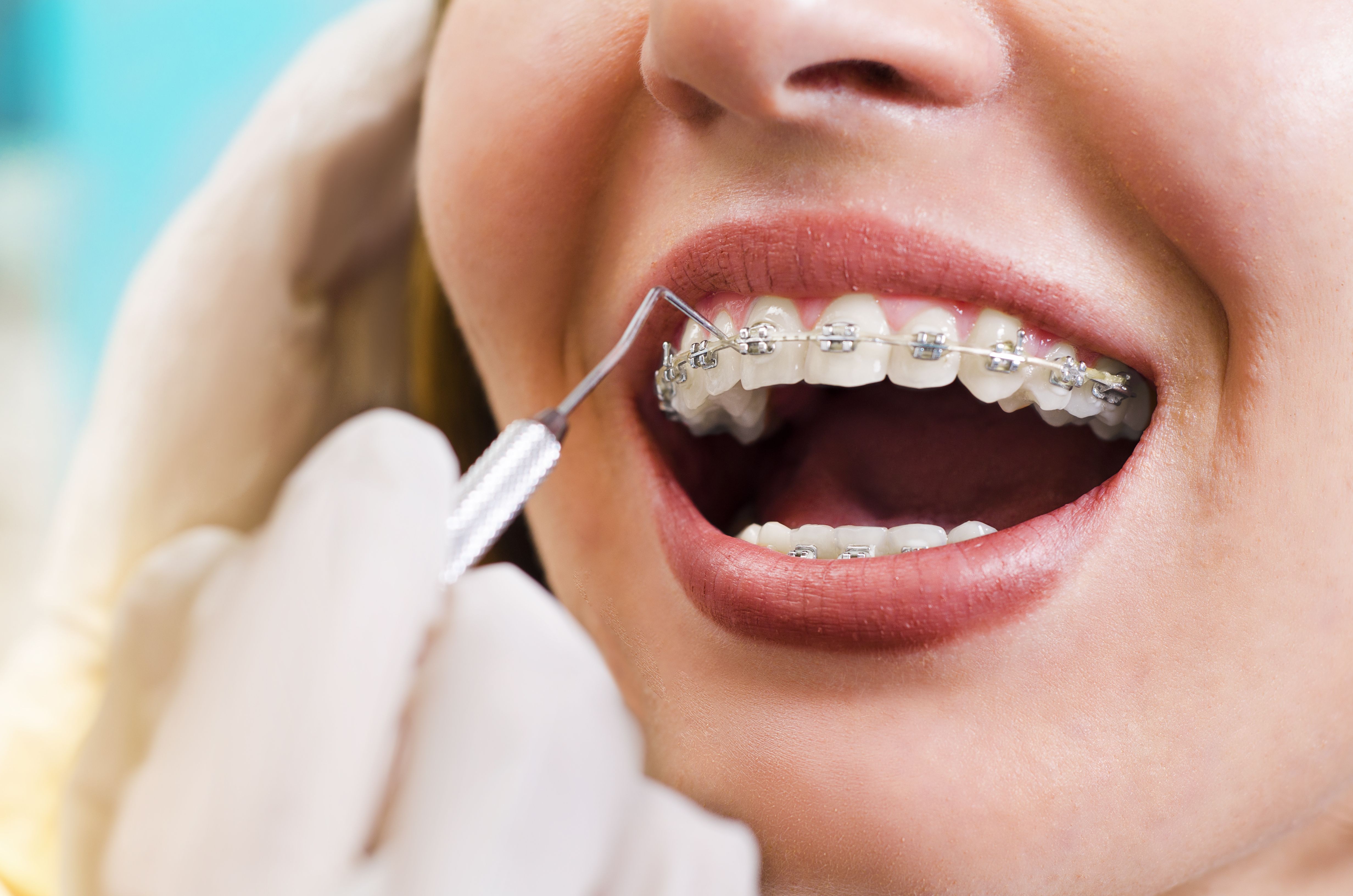 Ortodoncia en adultos: Tratamientos de Centro Médico Dental Capitol Ortodoncia en adultos: Tratamientos de Centro Médico Dental Capitol
