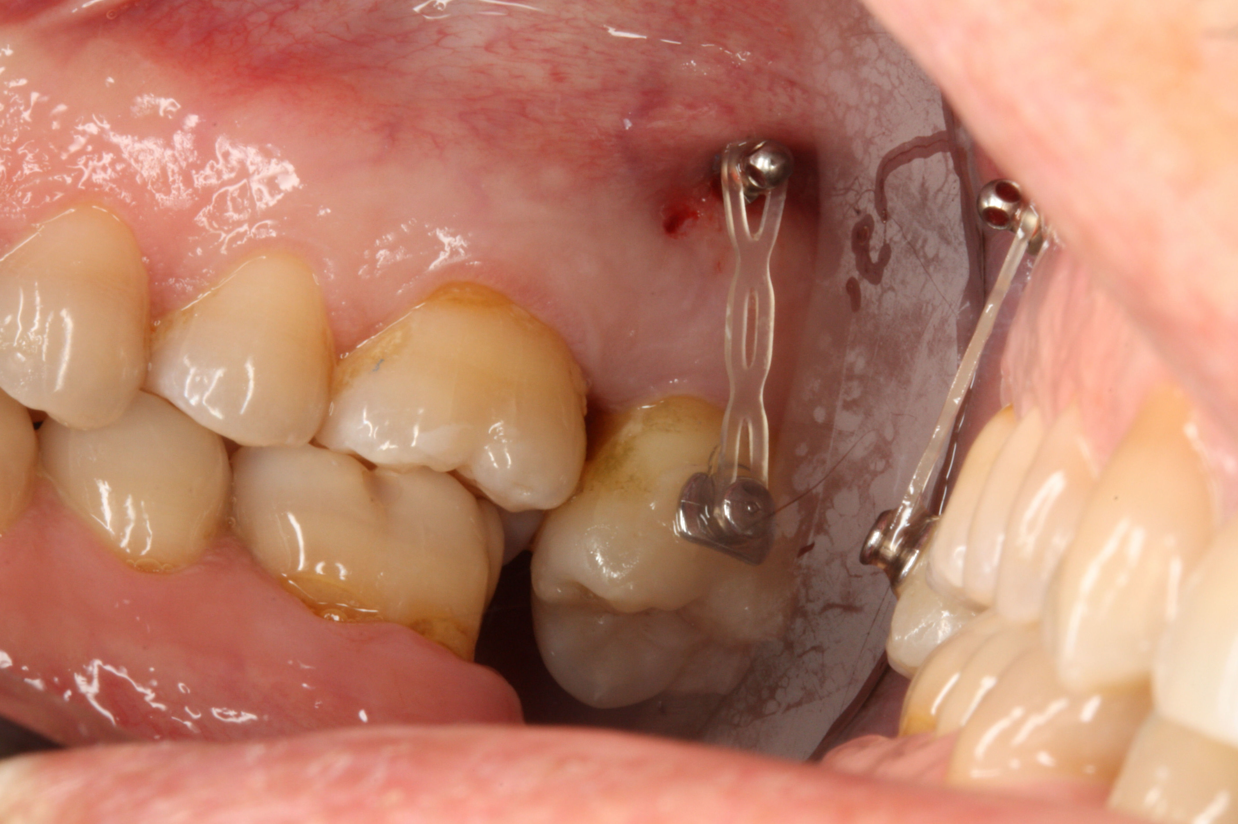 Microimplantes para ortodoncia: Tratamientos de Centro Médico Dental Capitol Microimplantes para ortodoncia: Tratamientos de Centro Médico Dental Capitol
