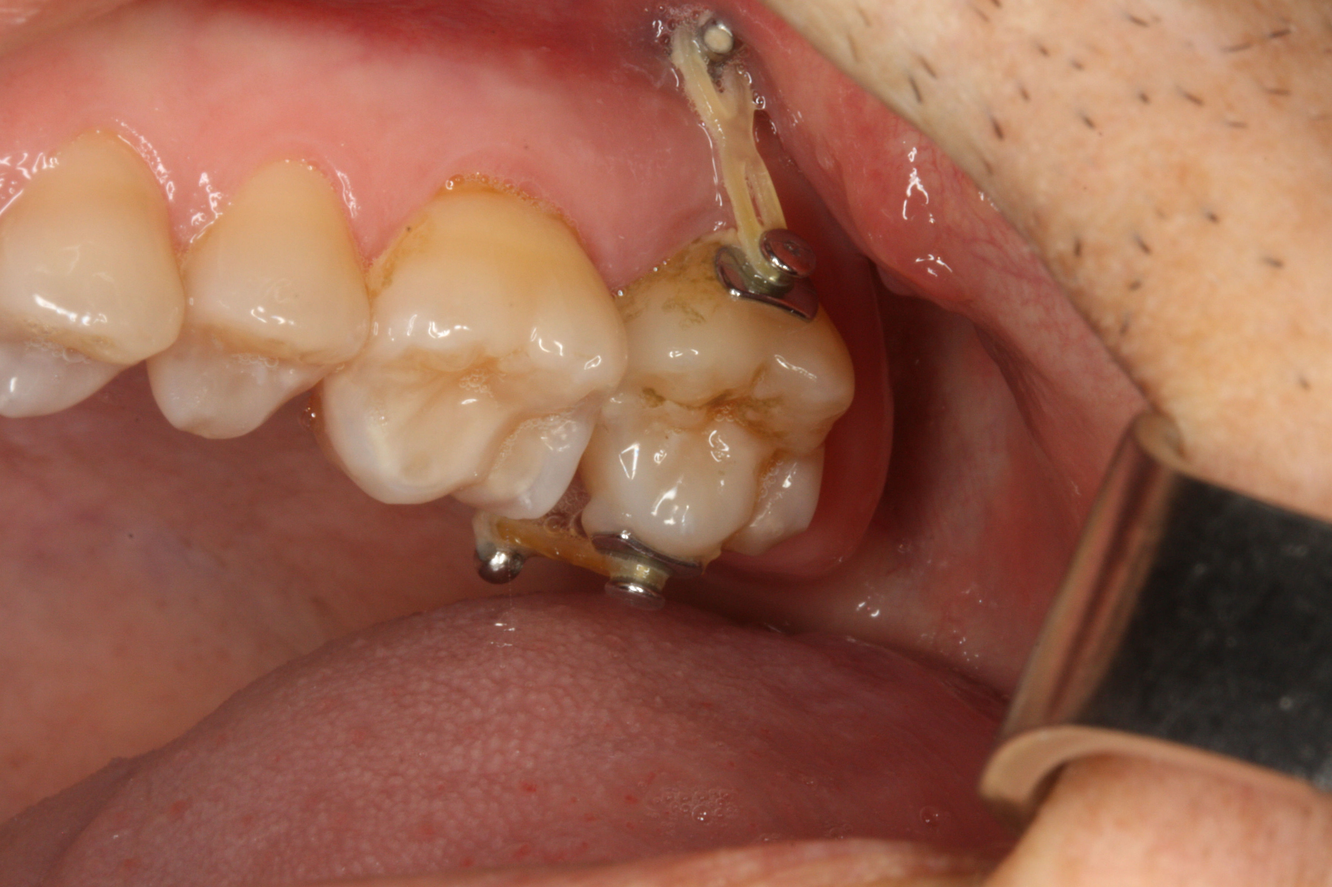 Microimplantes para ortodoncia: Tratamientos de Centro Médico Dental Capitol Microimplantes para ortodoncia: Tratamientos de Centro Médico Dental Capitol