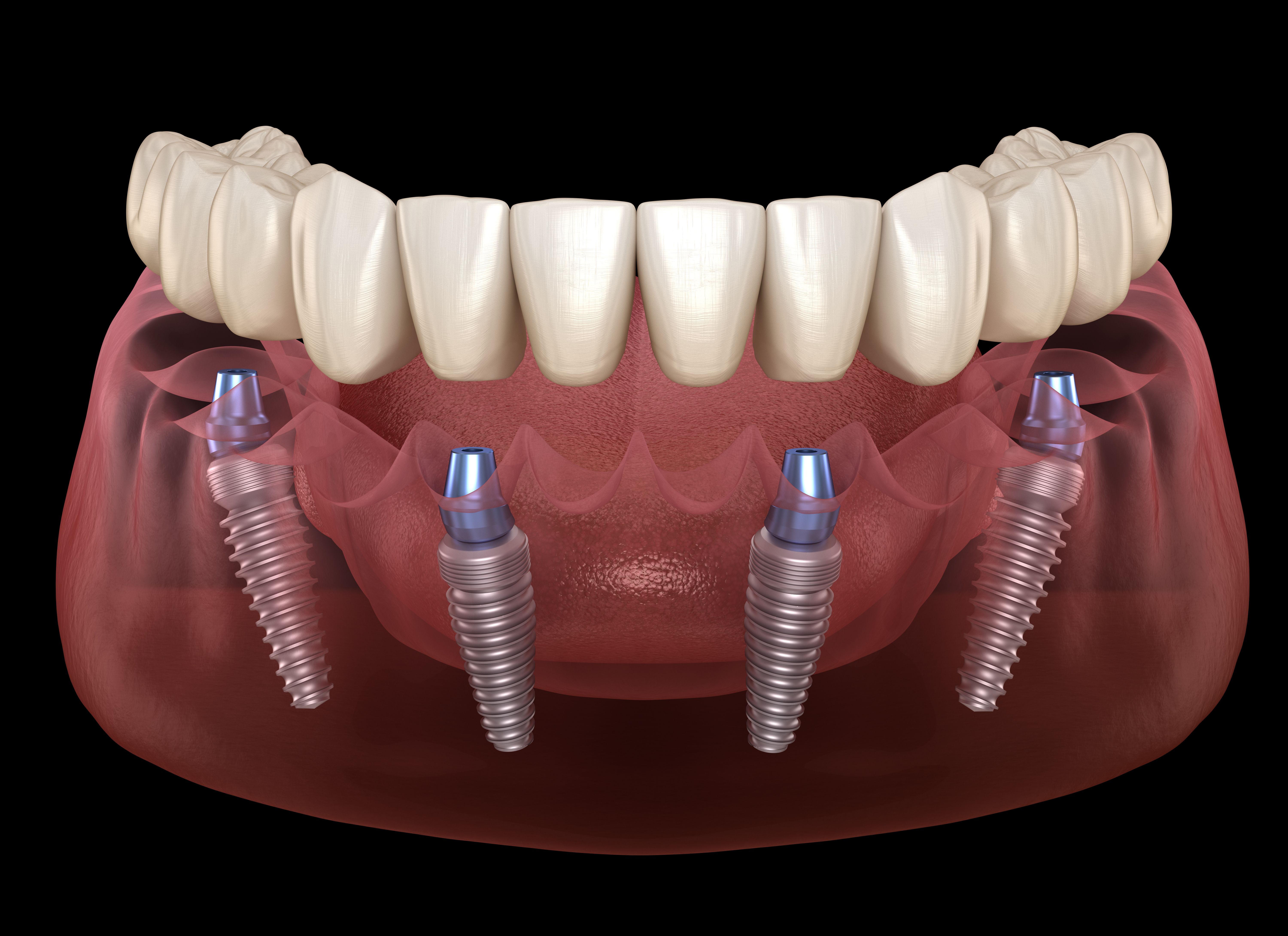 Prótesis dentales fijas: Tratamientos de Centro Médico Dental Capitol Prótesis dentales fijas: Tratamientos de Centro Médico Dental Capitol
