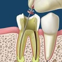 Endodoncias: Servicios de Centro Dental Bizkai-Dent Endodoncias: Servicios de Centro Dental Bizkai-Dent