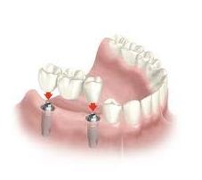 Implantes dentales: Servicios de Centro Dental Bizkai-Dent Implantes dentales: Servicios de Centro Dental Bizkai-Dent