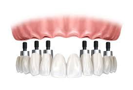 Prótesis dental: Servicios de Centro Dental Bizkai-Dent Prótesis dental: Servicios de Centro Dental Bizkai-Dent