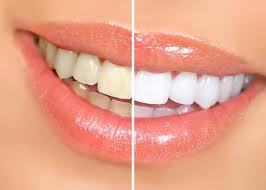 Blanqueamientos dentales: Servicios de Centro Dental Bizkai-Dent Blanqueamientos dentales: Servicios de Centro Dental Bizkai-Dent