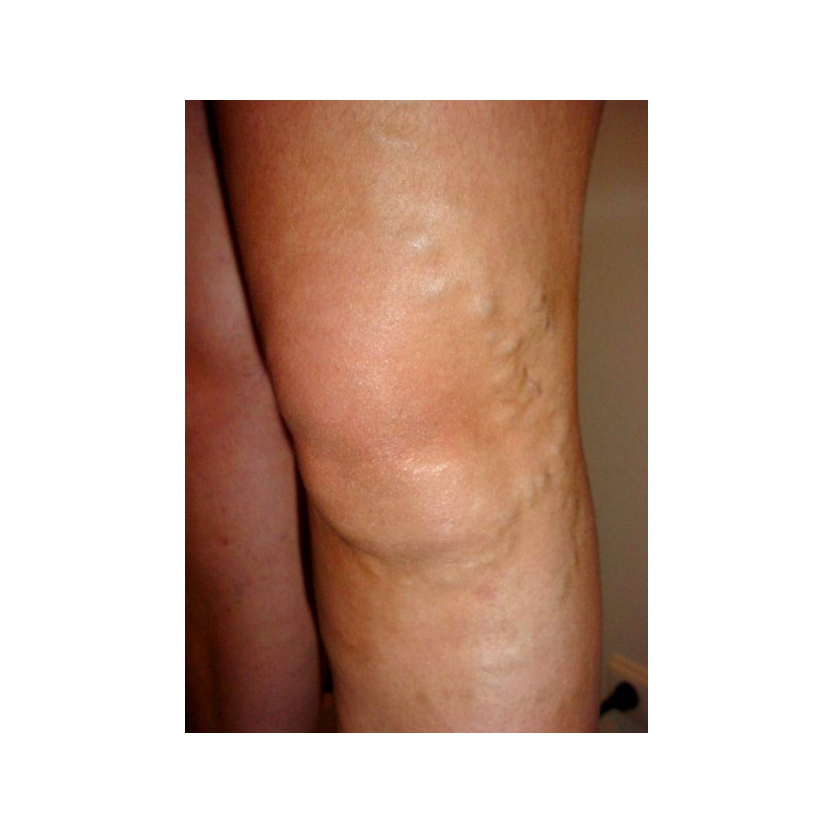 V. safena externa o menor: Tratamientos de Centro Adiós Varices V. safena externa o menor: Tratamientos de Centro Adiós Varices