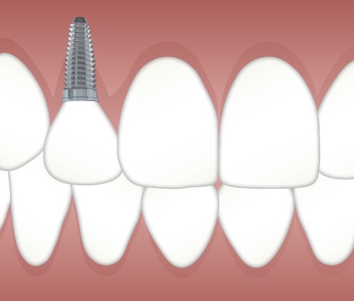 Implante dental: Servicios de Clínica Dental Dr. Ignacio Belsué Implante dental: Servicios de Clínica Dental Dr. Ignacio Belsué