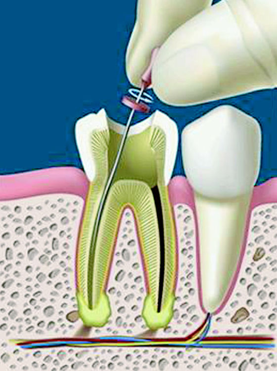 Endodoncia Basauri