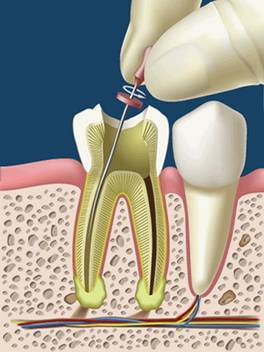 ENDODONCIA: SERVICIOS de Clínica Dental Basauri