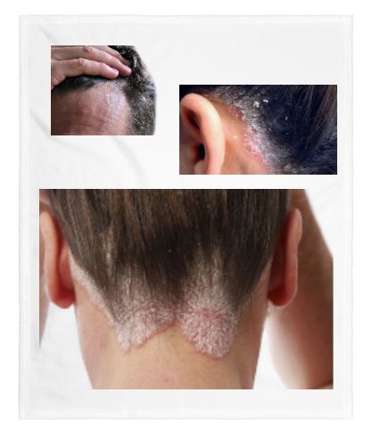 Psoriasis: Peluquería unisex de Cristina Paulo Peluquería Unisex Psoriasis: Peluquería unisex de Cristina Paulo Peluquería Unisex