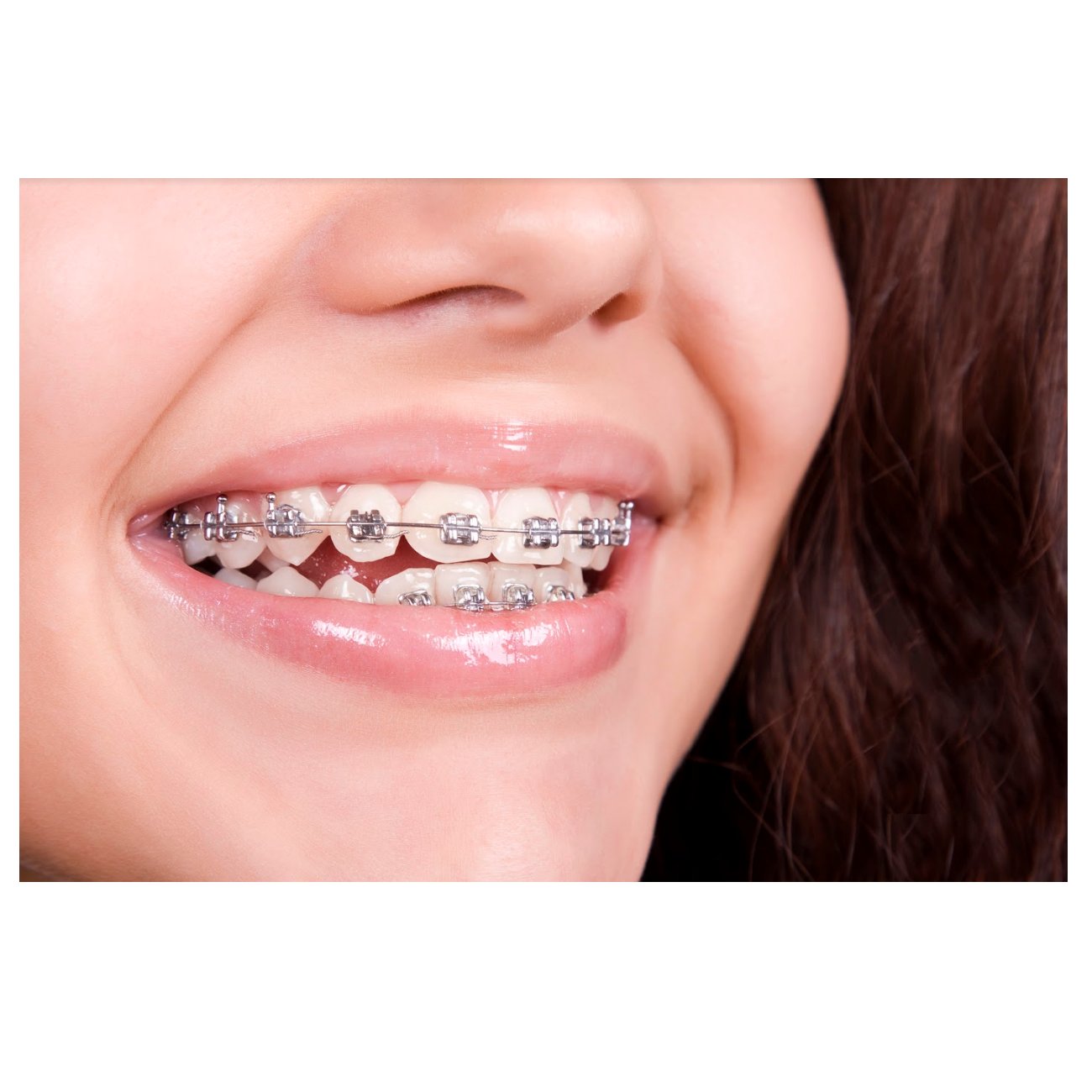 Brackets metálicos: Tratamientos de Clínica Dental Dra. Ana Lucía Brackets metálicos: Tratamientos de Clínica Dental Dra. Ana Lucía