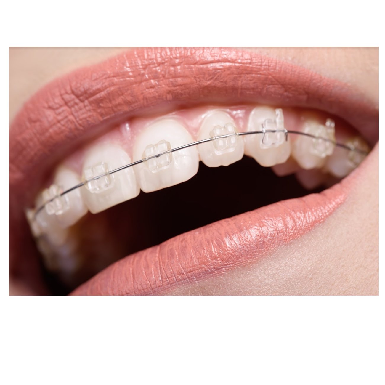 Brackest estéticos: Tratamientos de Clínica Dental Dra. Ana Lucía Brackest estéticos: Tratamientos de Clínica Dental Dra. Ana Lucía