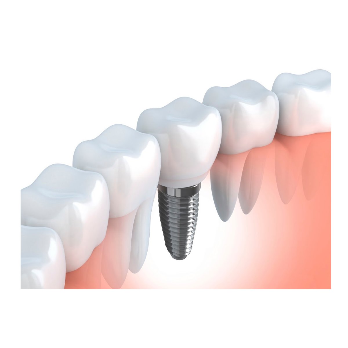 Implantes: Tratamientos de Clínica Dental Dra. Ana Lucía Implantes: Tratamientos de Clínica Dental Dra. Ana Lucía